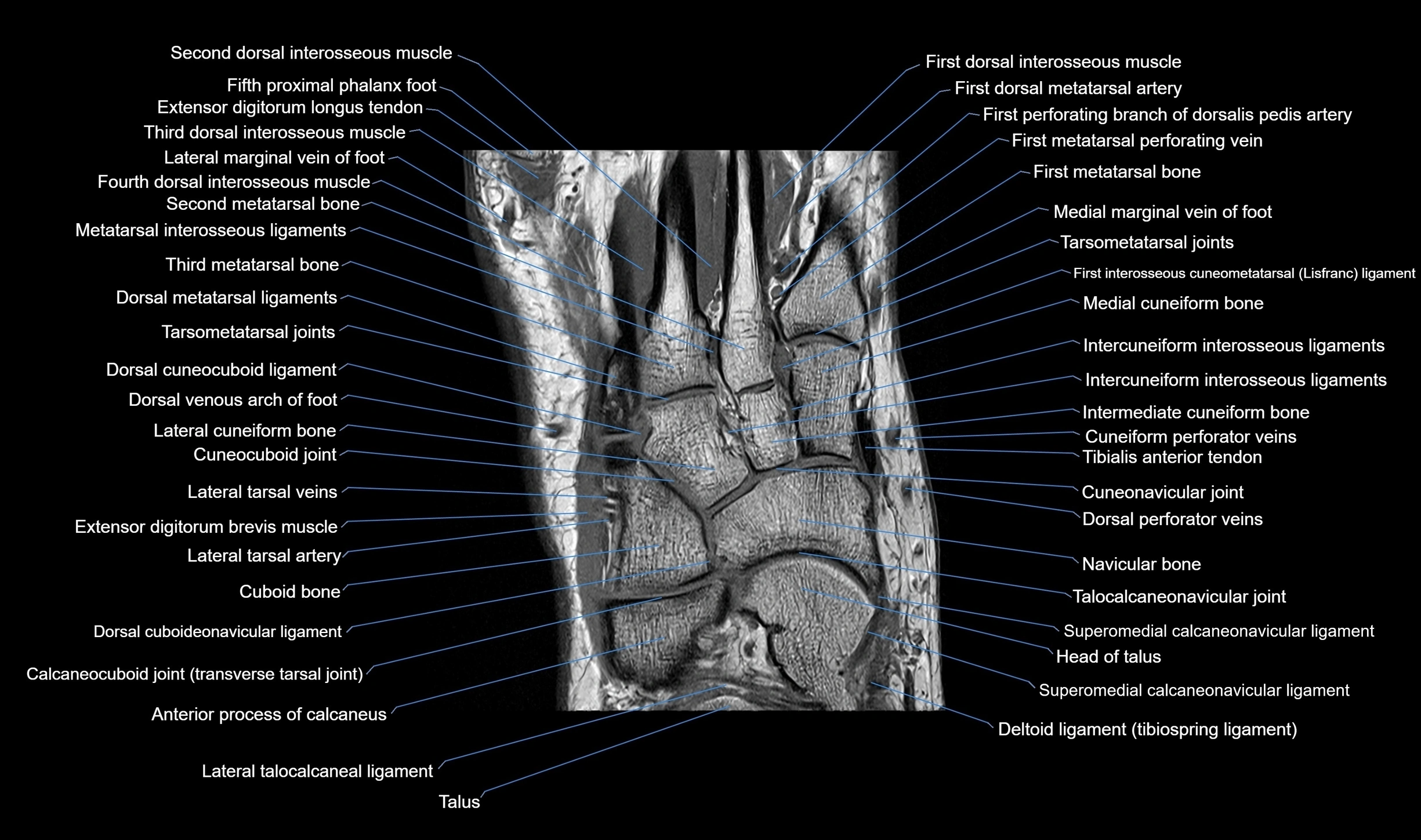 MRI mid foot coronal ligaments cross sectional anatomy 3T  radiology  image-img-00001-00019.webp